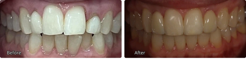 before-after